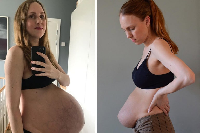 belly after birth